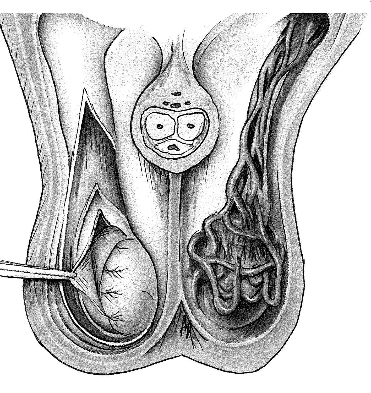  Varicocele  South West Andrology